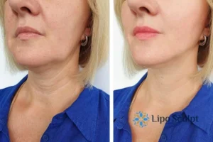 Double chin before and after Hi-Fu treatment 4 Book your double chin treatment Brierley Hill today! We are here to help!