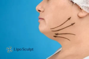 Double chin before and after Hi-Fu treatment 3 Boost your confidence with a Double chin treatment Brierley Hill