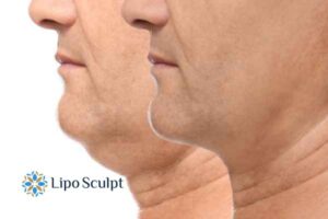 Double chin before and after Hi-Fu treatment 2 Double chin treatment Brierley Hill from Lipo Sculpt - feel more confident today!
