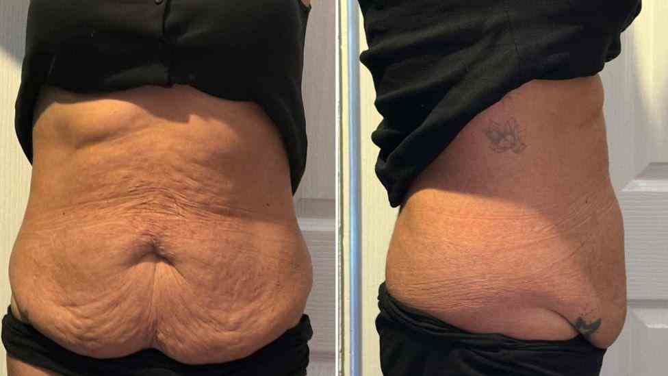 Lost the Weight but Not the Loose Skin? What You Should Know 1 Is It Definitely Loose Skin Brierley Hill?